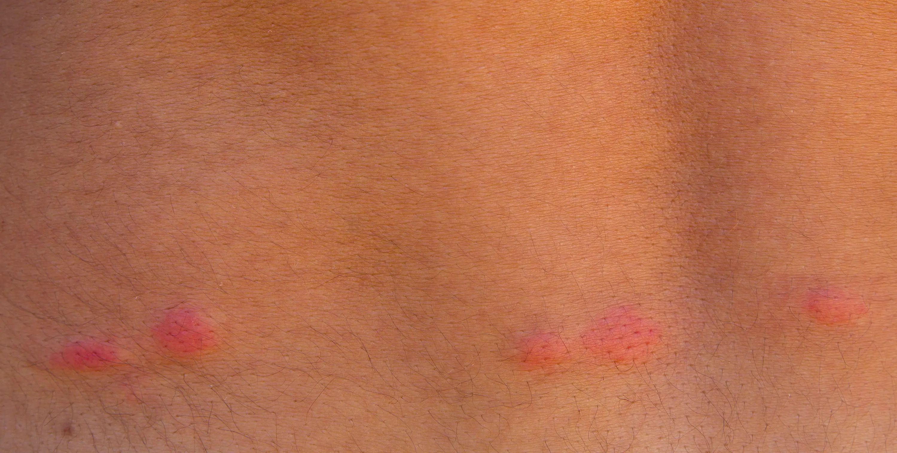 Flea Bites vs Bed Bug Bites: How to Tell the Difference