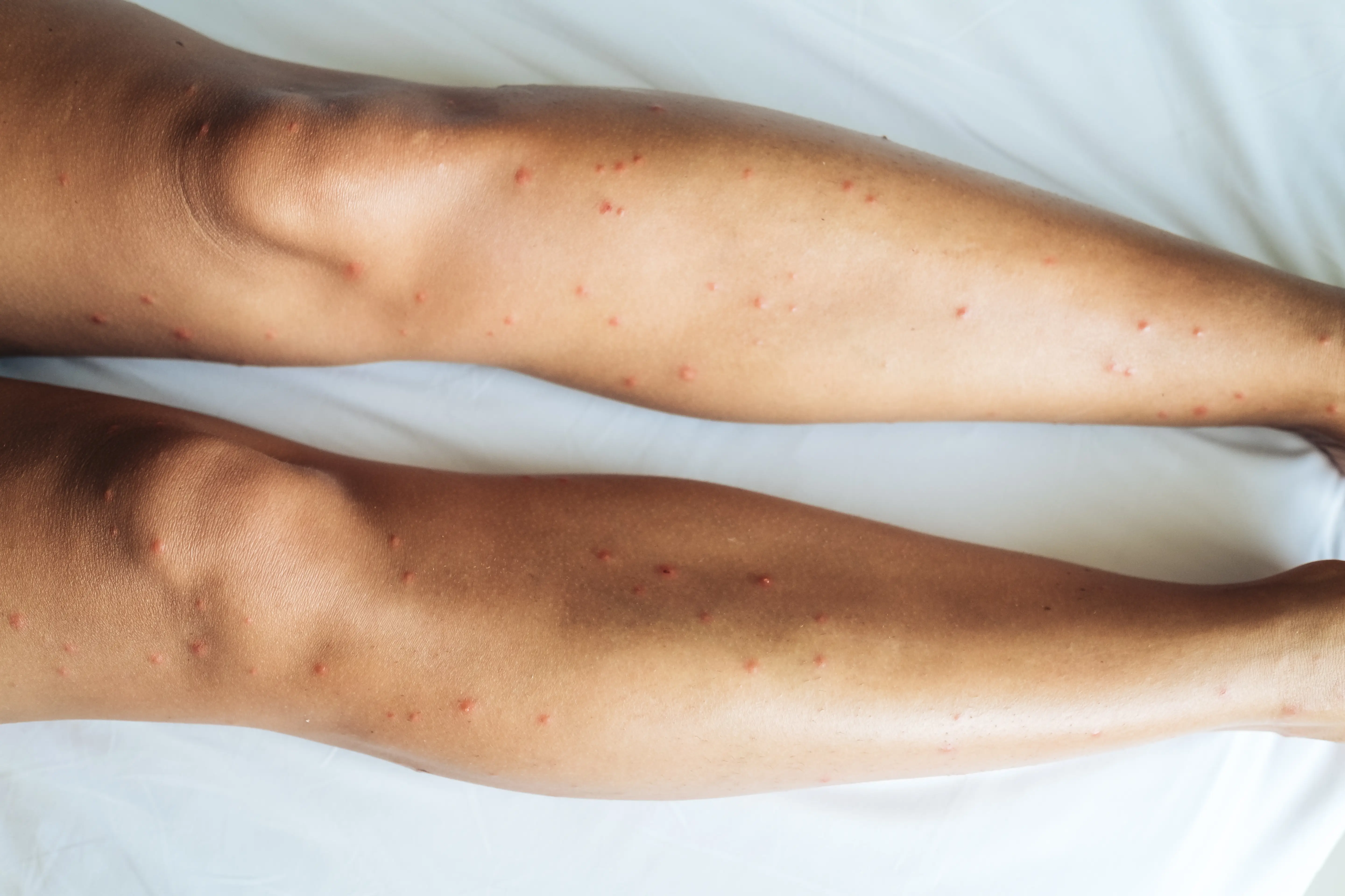 Am I Allergic to Mosquito Bites? Skeeter Syndrome Guide